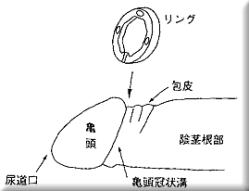 包茎矯正リング